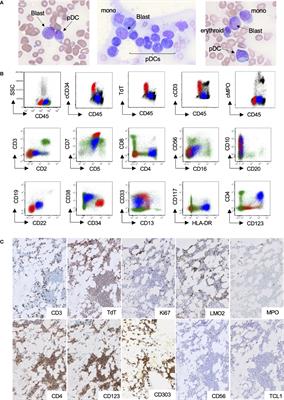 Case Report: Mature Plasmacytoid Dendritic Cell Proliferation Associated With a Lymphoid Neoplasm